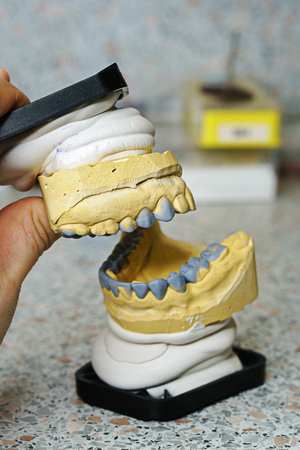 Dental impressions of teeth for manufacture of prostheses and correcting bite. Lower and upper jaw