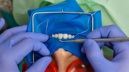 Dentist makes inspection of girl patient. Dentistry. Dental expander for mouth. Gum fixation. Dental...