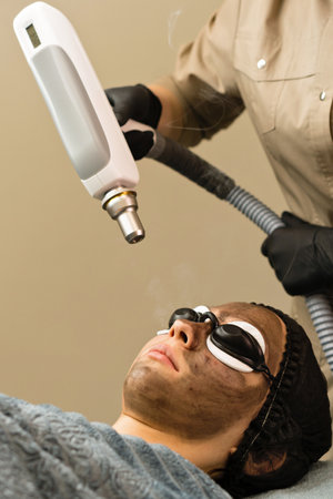 Carbon face peeling procedure in beauty salon. Laser pulses clean skin face. hardware cosmetology. Process photothermolysis. facial skin rejuvenation.の写真素材