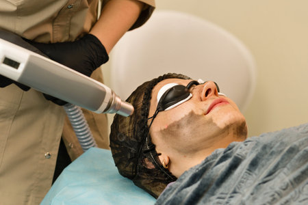 Carbon face peeling procedure in beauty salon. Laser pulses clean skin face. hardware cosmetology. Process photothermolysis. facial skin rejuvenation.の写真素材