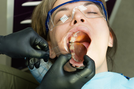 Examination oral cavity with retractor and mirror. Maxillary molar missing. Female patient in dental...