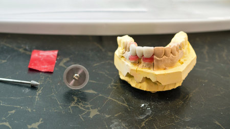 Dental crowns and veneers on plaster model artifical jaw