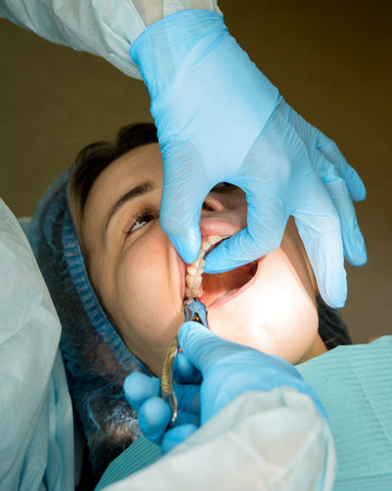 Dental surgeon removing wisdom tooth, the maxillary third molar female patient's. real procedure. close up imageの写真素材