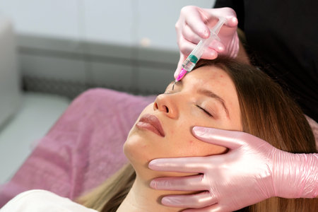 Patient receiving non-surgical brow skincare to reduce wrinkles. Biorevitalization peel for women at cosmetology clinic. Innovative dermal stimulatorの写真素材