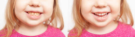 Girl child smiling before, white teeth after brushing and whitening, childhoodの写真素材