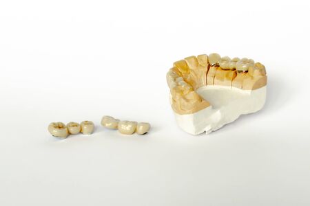 prosthetics for missing teeth. false teeth. ceramic-metal dental bridges. gypsum model of the upper jaw. aesthetic prosthetics. White backgroundの写真素材