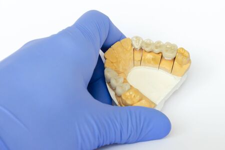 ceramic-metal bridges. non-permanent dental prosthetics. orthopedic dentistry. false teeth. ceramic teeth, ceramic bridgesの写真素材