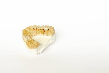 bridges on the lateral teeth. ceramic-metal bridges. fake ceramic teeth. orthopedic dentistry....