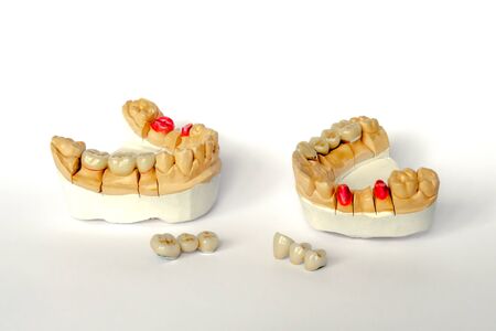 concept of orthopedic dentistry. dental prosthetics with ceramic crowns and bridges. dental bridges on the posterior teeth. aesthetic prosthetics. gypsum models of the lower and upper jaw. White backgroundの写真素材