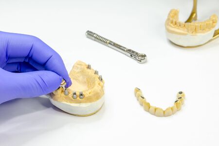 production of a fixed denture on implants. ceramic bridge on implants. dentist hand unscrews abutmentの写真素材