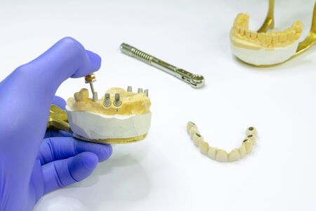 prosthetics on dental implants. concept of orthopedic dentistry. ceramic bridge on implants. dentist's hand holds a plaster jaw with dental abutmentsの写真素材