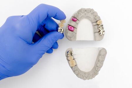tooth restoration. dental prosthetics. the dentist's hand holds a model of teeth with dental crowns....