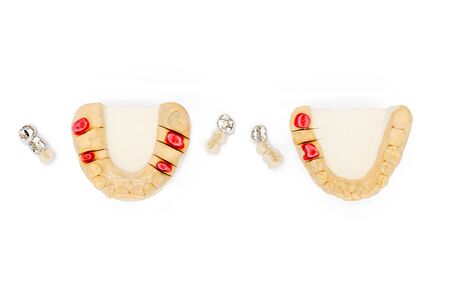 dental crowns and bridges. ceramic-metal crowns. dental prosthetics. false teeth. isolatedの写真素材
