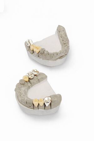metal-ceramic dental crowns and bridges. dental prosthetics. artificial teeth. teeth models with crowns isolated on white backgroundの写真素材