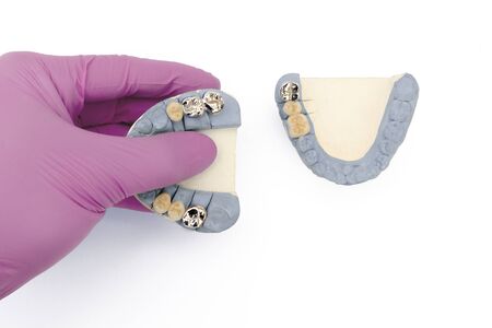 ceramic-metal crowns and bridges on the upper and lower jaws. dental prosthetics. dentistry conceptの写真素材