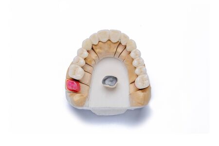 ceramic-metal crowns. ceramic-metal bridge. artificial tooth. White teeth. orthopedic dentistry. dental prosthetics. Isolated on a white backgroundの写真素材