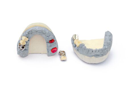 metal and ceramic artificial teeth. concept of replacing missing teeth. dental prosthetics. isolatedの写真素材