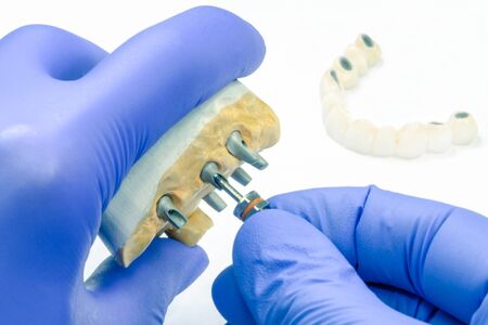 the dentist spins the dental implant. the concept of prosthetics on dental implants and the...
