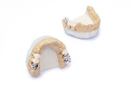 ceramic-metal bridges on the models of the upper and lower jaws. prosthetics of damaged and missing teeth. isolatedの写真素材