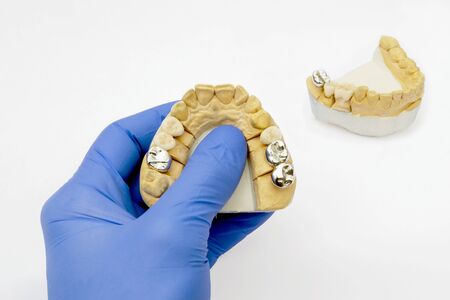 a dentist in a glove holds fake teeth. in the background is a model with metal and ceramic crowns. concept of orthopedic dentistry.の写真素材