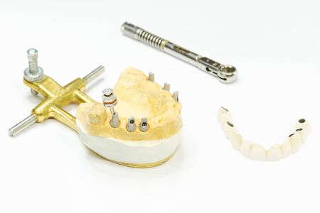 the process of manufacturing ceramic teeth on implants. dental implants with ceramic teeth on a light background. concept of dental implantation and dental prosthetics on implants.の写真素材