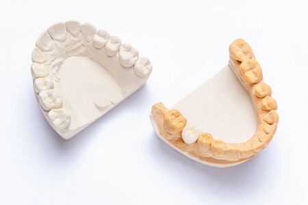 on a white background are plaster models of the jaws with a ceramic crown made on a molar. white artificial tooth on the implant. concept of orthopedic dentistryの写真素材