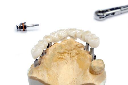 the process of manufacturing ceramic teeth on implants. dental implants with ceramic teeth on a light background. concept of dental implantation and dental prosthetics on implants.の写真素材