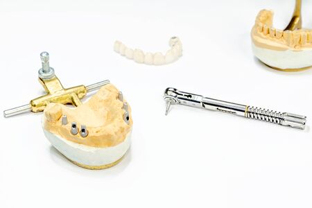 the process of manufacturing ceramic teeth on implants. dental implants with ceramic teeth on a light background. concept of dental implantation and dental prosthetics on implants.の写真素材