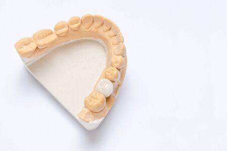 on a white background is a plaster model of the lower jaw with a ceramic crown made on a dental implant. dental prosthetics concept. crown makingの写真素材