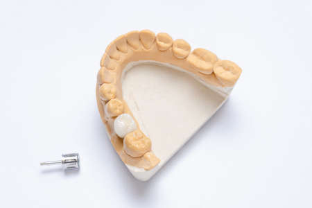 ceramic crown molar on a dental implant. lower jaw plaster modelの写真素材