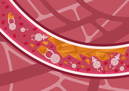 Future of medicine. Nanobots in action. Nanorobots detecting, destroying and eliminating cholesterol plaques in blood vesselsのイラスト素材