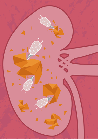Future of medicine. Nanobots in action. Nanorobots eliminating kidney stones, alternative of nephrolithotomyのイラスト素材
