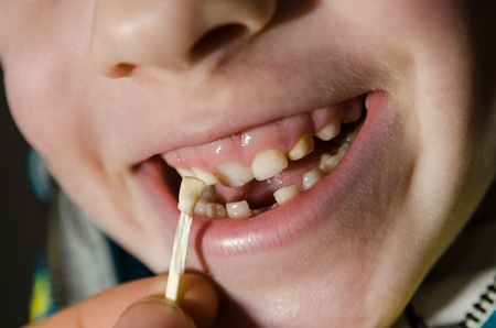 little boy with a fallen tooth. Child opening his mouth.の写真素材