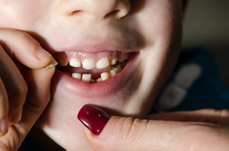 Child opening his mouth with a fallen tooth. Boy smilling in dentistry concept.の写真素材