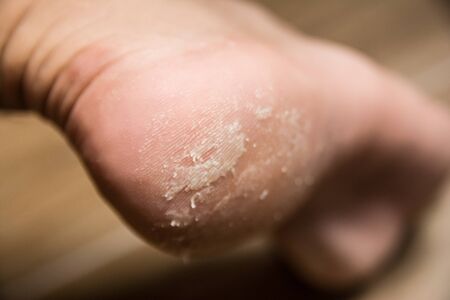 Feet with dry skin needing treatment. heel pain and diseaseの写真素材