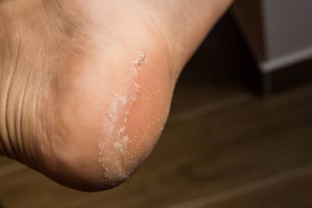 Feet with dry skin needing treatment. heel pain and diseaseの写真素材