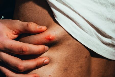 Big red pimple on a man's back, close up of an abscessの写真素材