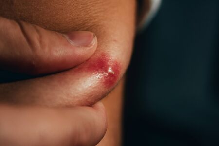 man squeezes a big red pimple on his back. close up of removing  acne spot. skin care concept.の写真素材
