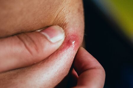 man squeezes a big red pimple on his back. close up of removing  acne spot. skin care concept. selective focusの写真素材