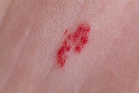 Selective focus closeup of red hemangioma on pale caucasian skin. Small blond hairs are visible...