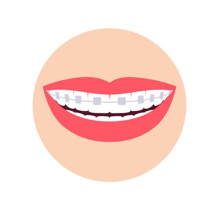 Orthodontic braces on teeth. Smile isolated on a white background. Vector illustrationのイラスト素材