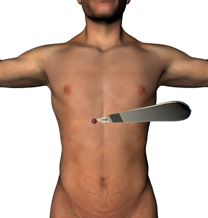 LESS surgery abdomen incision scalpel a human body  Minimally invasive surgery, a single micro cutting with a scalpelの写真素材