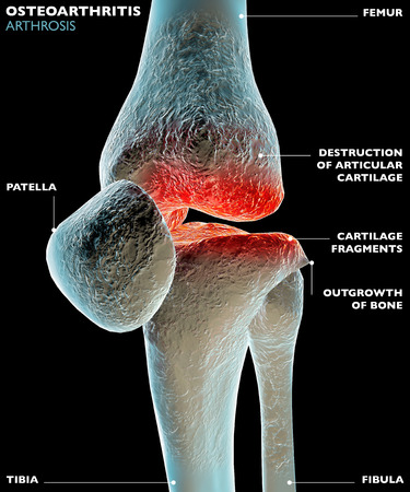 Human knee leg bone painの写真素材