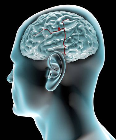 Cerebral aneurysm, brain head  Head in profile to the x-ray with brain aneurysmの写真素材