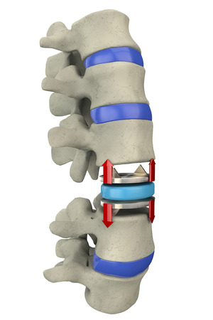 Artificial disc replacement, spine  Surgical operationの写真素材