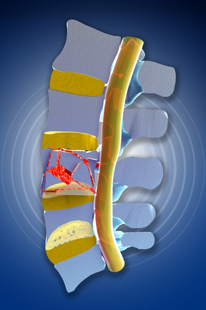 Plugs, marrow, traumatic vertebral fractures, burst fracture. Spine sectionの写真素材