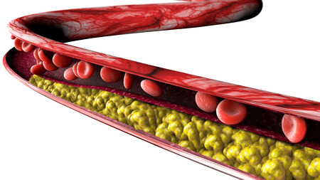 Cholesterol formation, fat, artery, vein, heart. Narrowing of a vein for fat formationの写真素材