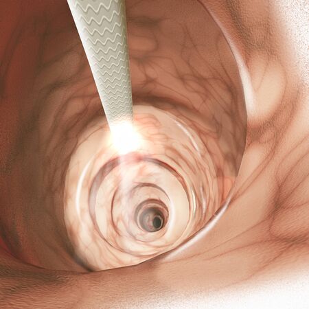 Internal view of the intestinal walls. Colonoscopy is the endoscopic examination of the large bowel and the distal small bowel with a camera on a flexible tube. 3d renderの写真素材