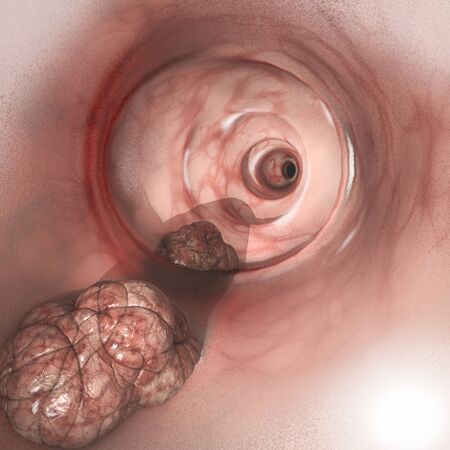 Internal view of the intestinal walls. Colorectal cancer (CRC), bowel cancer, colon cancer, or...