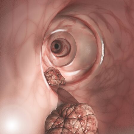Internal view of the intestinal walls. Colorectal cancer (CRC), bowel cancer, colon cancer, or rectal cancer. Abnormal growth of cells that invade or spread to other parts of the body. 3d renderの写真素材